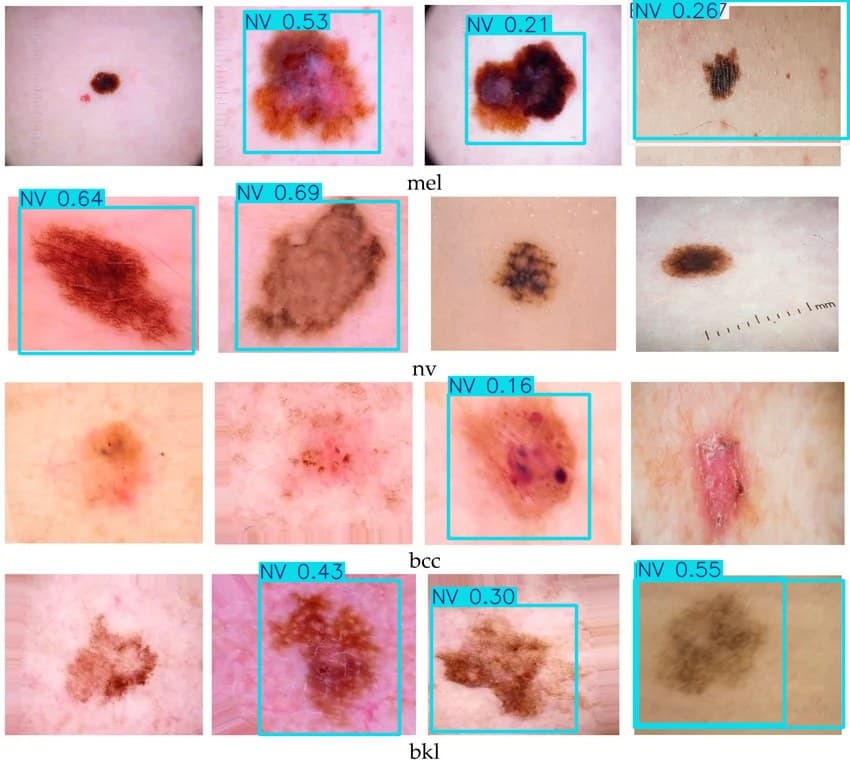 yolov11s-skin-lesion-isic2018