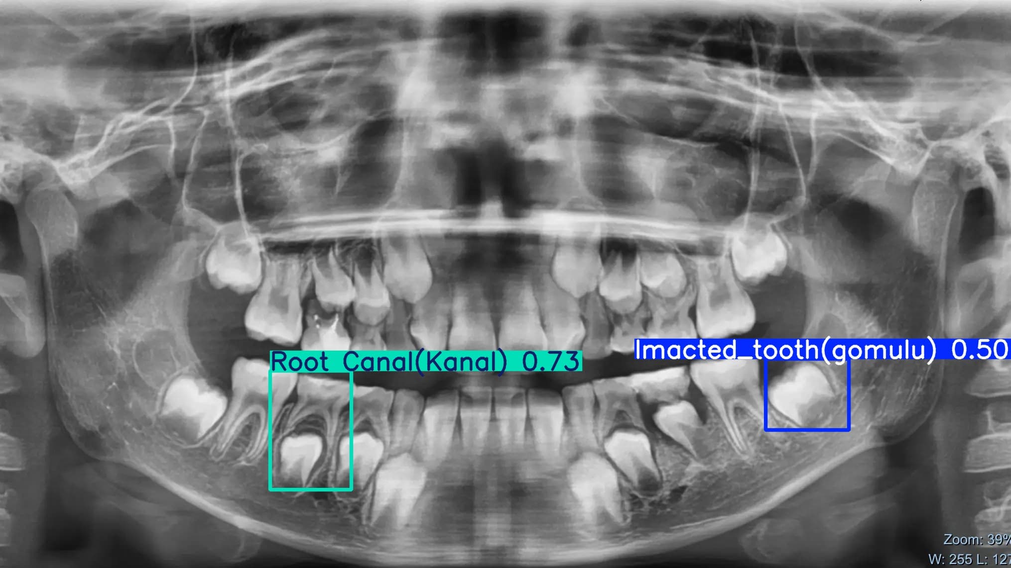 Dental-anomalies-yolov8