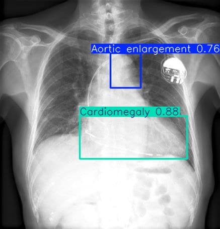chest-xray-yolov8-detection