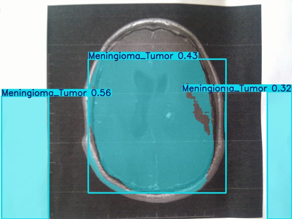 Brain_tumor_segmentation_yolov8